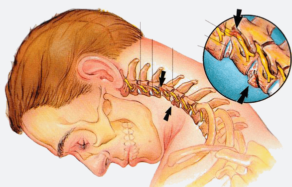 Osteochondrosis stages of the cervical spine